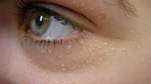 Cara hilangkan bintik putih kolesterol di bawah mata. Cara Hilangkan Bintik Kolestrol Di Bawah Mata Dengan Mudah