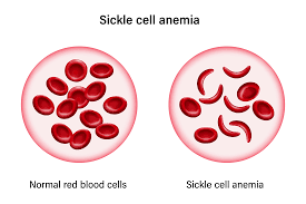 Image result for Anemia