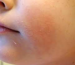 Fortunately, there are a few brands that make toilet papers specially designed for sensitive skin. Allergic Contact Dermatitis From Baby Wipes Consultant360