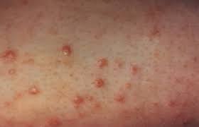 An itchy rash and sometimes tiny blisters, dry scaly skin, or a white discharge that looks like cottage. Skin Manifestations Of Diabetes Mellitus Endotext Ncbi Bookshelf