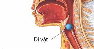 Tìm hiểu các cách lấy dị vật trong họng an toàn