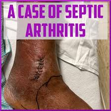 Image result for Septic Joint