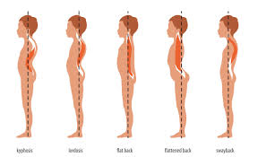 Faqs About Flatback Syndrome