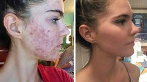 Cara menghilangkan jerawat dengan menggunakan lidah buaya untuk menghilangkan jerawat adalah kerok gel lidah buaya secara langsung dengan menggunakan sendok. Cara Aman Hilangkan Jerawat Dengan Bahan Alami Pakai Air Mawar Dicampur Air Jahe Hingga Sari Apel Tribun Manado
