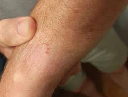 Image result for Bat Bite