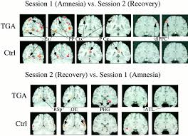 Image result for Transient Global Amnesia