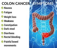Signs and symptoms of colon cancer include: What Are Some Signs And Symptoms Of Colon Cancer