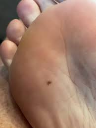 Image result for brown patches on the feet