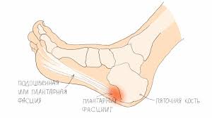 Пяточная шпора или плантарный фасциит