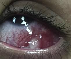 Check spelling or type a new query. Infected Conjunctival Pyogenic Granuloma At Strabismus Surgery Site Mimicking Conjunctival Abscess Sciencedirect