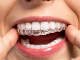 Transform Your Smile with Invisalign at Jasper Dentist TX