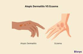 Image result for Atopic eczema atopic dermatitis