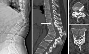 Maybe you would like to learn more about one of these? References In Ossified Ligamentum Flavum Causing Neurological Deficit Above The Level Of Post Tuberculous Kyphotic Deformity Journal Of Clinical Orthopaedics Trauma