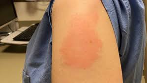 This delayed skin reaction occurred in less than 1% of phase 3 clinical trial participants, according to a letter to the editor published in the new england journal of medicine. Mgh Researchers Report Delayed Skin Reaction To Covid 19 Vaccine
