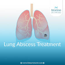 Image result for Lung Abscess