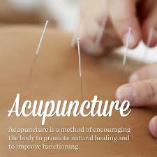 Image result for acupuncture images
