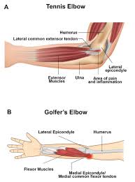 Image result for Epicondyle Injection