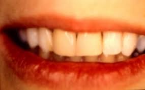 Check spelling or type a new query. Dentiste Amouyal A Paris 16 Remplacement De Couronnes Dentaires Ceramo Metalliques En Ceramique Pure