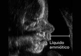 El líquido amniótico se encarga de envolver y proteger al bebé durante todo el embarazo, su volumen varía a lo largo de todo el proceso, pero pueden existir problemas por exceso de cantidad o por defecto. Medicina Digital Lanza En Mexico Prueba Ambulatoria De Deteccion De Perdida De Liquido Amniotico No Invasivo Y Ambulatorio