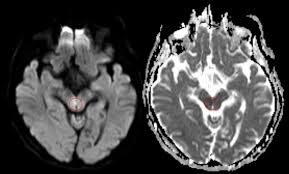 Hirninfarkt Ischamischer Schlaganfall Pathophysiologisches Fachwissen