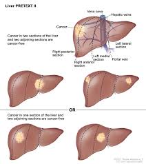 Childhood Liver Cancer Treatment Pdq Health Professional