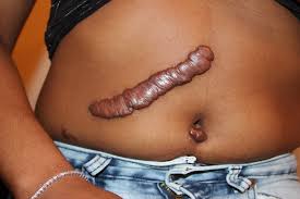 Avoid!keloids & hypertrophic scars are basically treated the same skin: Keloid Wikipedia