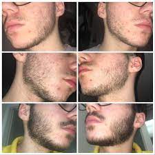 18 Y O Was Told I Cant Grow A Beard And Started Using Minoxidil Top Is About 2 3 Weeks Before Middle Is A Month Grow Beard Beard Growth Tips Minoxidil Beard