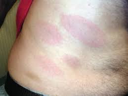 Jan 28, 2021 · les maladies infectieuses virales (grippe, mononucléose infectieuse, covid 19, etc.), bactériennes (pyélonéphrite, tuberculose, maladie de lyme, etc.) ou, plus rarement, parasitaires sont fréquemment à l'origine d'une fatigue qui passe avec leur guérison et la fin de la convalescence. Pour Les Professionnels De La Sante Maladie De Lyme Canada Ca