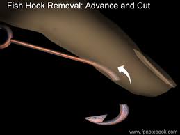 Image result for Fishhook Removal
