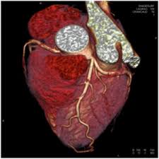 After the initial inflammatory phase, inflammation resolves and fibrosis can seen. Diagnostik Kardiologie Darmstadt