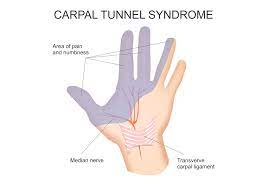 Carpal Tunnel Syndrome Faqs