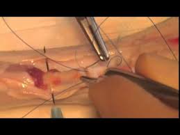 We then carried out a nationwide there have been many different techniques described for the repair of digital flexor tendons, including the kessler repair 16, which was modified in 1979. Modified 2 Core Kessler Suture Youtube