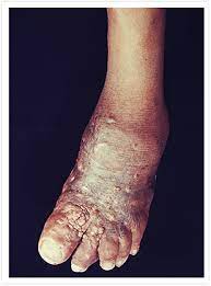 Browse 13 madura foot stock photos and images available, or start a new search to explore more stock. Mycetoma About Ntds Eisai Atm Navigator