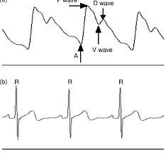 Radial Arterial Pulse Pressure Wave And Ecg A The Typical