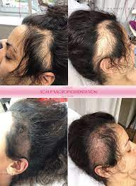 But it can be treated and hair can grow back. Alopecia Areata Behandlung Mit Permanent Make Up Beauty Art