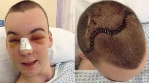 Stoke major trauma centre helps Wrexham crash victim