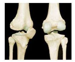 Articulations, des genoux aux petits soins. Arthrose Du Genou La Gonarthrose Dossier