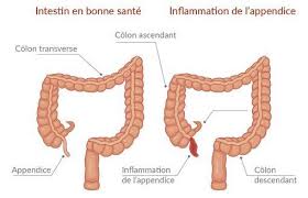 La peritonite è un'infiammazione della membrana sierosa che riveste i visceri e la cavità addominale. Appendicite De L Adulte Symptomes Et Traitement Doctissimo