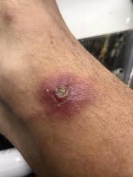 Far more brown recluse bites are reported than proven, and plenty of confusion remains about what these spider bites actually look and feel like. Brown Recluse Bite Off Topic Discussion Forum