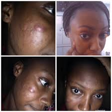 For a healthy and beautiful skin try MAX357 limited stock available call  0240358023 for your orders