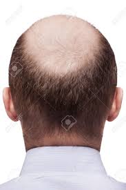 This type of hair loss is called traction alopecia. Human Alopecia Or Hair Loss Adult Man Bald Head Rear Or Back Stock Photo Picture And Royalty Free Image Image 12928873