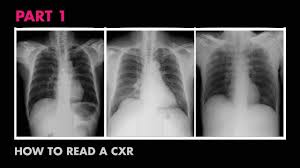 Cardiac Silhouette How To Read A Chest X Ray Part 7 Medzcool Youtube