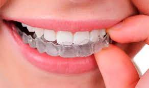 However, if your mouthguard isn't molded to your teeth, it might not be comfortable in your mouth, may not properly protect you, or could even fall out at. How To Mold A Perfect Mouthguard Step By Step Guide With Video Explanation 2021