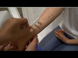 Deri Alerji Testleri Nasil Yapiliyor Prof Dr Nilgun Solak Dermatoloji Uz Youtube