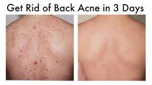 The location of the scar tissue has significant impact on whether a scar tissue leads to medical health issue or not and, in some severe cases, surgery may be required to get rid of the scar tissue. How To Get Rid Of Back Acne At Home In 3 Days Youtube