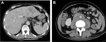 Specifically, they form in your liver, which is an organ that cleans your blood and helps your body process nutrients. Prostate Cancer With Multiple Metastases In The Patient Abdominal And Download Scientific Diagram