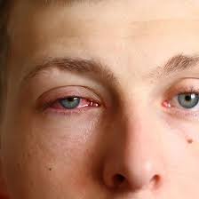 The duration requirement does not apply for ssi payments. Blindness Causes Type Treatment Symptoms