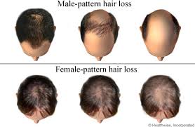 Maybe you would like to learn more about one of these? Hair Loss Cigna