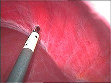 We did not find results for: Endometriose Wikipedia