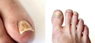 Toenail fungus pictures early stage. Toenail Fungus Treatment Phoenix Podiatrist Preferred Foot Ankle